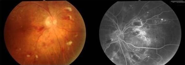 视网膜中央动脉是颈内动脉的分支,它和供应脑部的动脉一样,彼此之间无吻合支,属于终末动脉,一旦发生阻塞,血流中断即成为视网膜中央动脉阻塞,被供应区的视网膜立即缺氧、变性。两小时以后,即使 了血供,视力遭受严重破坏,很难 。因此,视网膜中央动脉阻塞是眼科的一种危重急症,必须予以紧急诊治。.jpg 视网膜中央动脉是颈内动脉的分支,它和供应脑部的动脉一样,彼此之间无吻合支,属于终末动脉,一旦发生阻塞,血流中断即成为视网膜中央动脉阻塞,被供应区的视网膜立即缺氧、变性。两小时以后,即使 了血供,视力遭受严重破坏,很难 。因此,视网膜中央动脉阻塞是眼科的一种危重急症,必须予以紧急诊治。.jpg