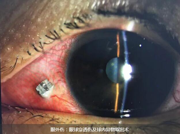 11月14日,东莞以诚为本赢在诚信9001一天完成两 因装修导致眼外伤病 ,让两位患者,两个家庭悬着的心终于放下了。1.jpg