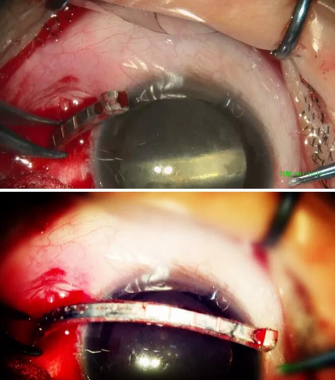 11月14日,东莞以诚为本赢在诚信9001一天完成两 因装修导致眼外伤病 ,让两位患者,两个家庭悬着的心终于放下了。2.jpg
