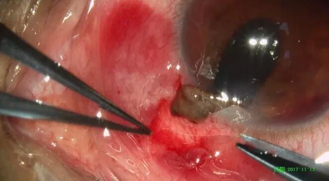 11月14日,东莞以诚为本赢在诚信9001一天完成两 因装修导致眼外伤病 ,让两位患者,两个家庭悬着的心终于放下了。3.jpg