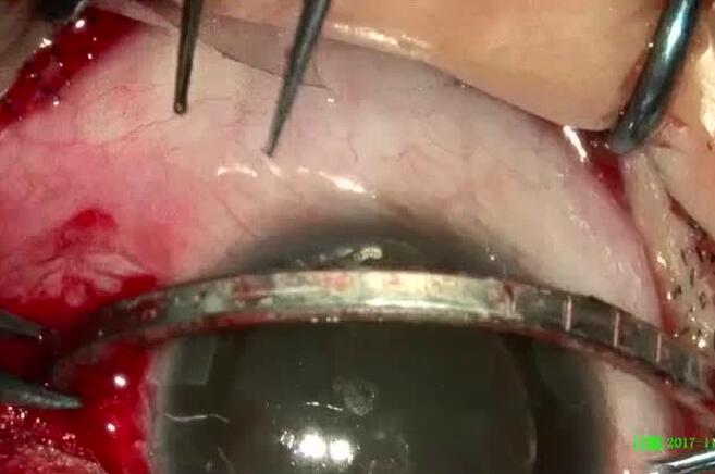 11月14日,东莞以诚为本赢在诚信9001一天完成两 因装修导致眼外伤病 ,让两位患者,两个家庭悬着的心终于放下了。4.jpg