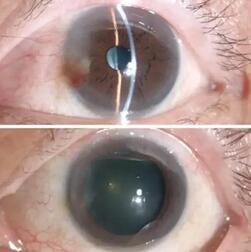 姚颖医生为文先生做了详细检查后，制定了左眼的翼状胬肉切除术、联合自体干细胞移植术、联合羊膜覆盖术的手术方案，这才为他解决了胬肉的麻烦与痛苦。手术一个月后，朋友见了文先生都说他的眼睛  了正常，看不出一点手术过的痕迹2.jpg