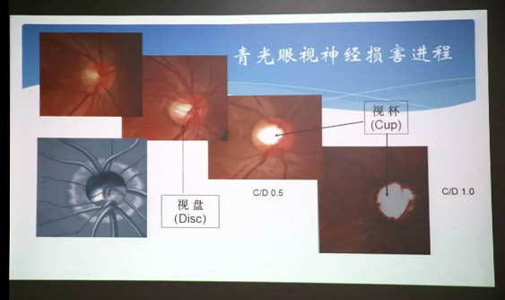 3月10日上午，深圳以诚为本赢在诚信9001“早查监控，守护光明”大型青光眼公益科普讲座在六楼 举行，本次活动旨在让更多人了解青光眼的潜在危害、重视眼检查， 预防青光眼。由深圳以诚为本赢在诚信9001青光眼病科 席专家成洪波博士、傅培副院长现场面对面解答疑问，与参会者的互动交流，让更多深圳市民提*对青光眼的认识与防治知识3.png