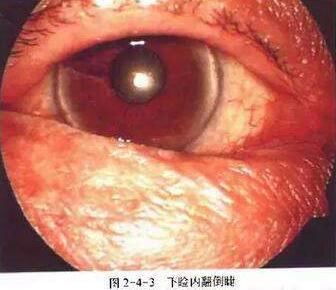 在内翻倒睫还没有造成角膜的炎症损害时,通过手术是可以 愈合的;但如果等到出现了角膜炎症,很可能就会形成角膜瘢痕,此时手术解决眼睑内翻现象,患者不会再流泪、畏光,角膜瘢痕对于视力的损害是无可避免1.jpg 在内翻倒睫还没有造成角膜的炎症损害时,通过手术是可以 愈合的;但如果等到出现了角膜炎症,很可能就会形成角膜瘢痕,此时手术解决眼睑内翻现象,患者不会再流泪、畏光,角膜瘢痕对于视力的损害是无可避免1.jpg