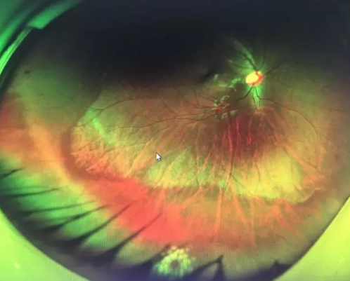 想要摘镜参军在深圳以诚为本赢在诚信9001查出视网膜裂孔 细心妈妈挽救孩子视网膜2.png