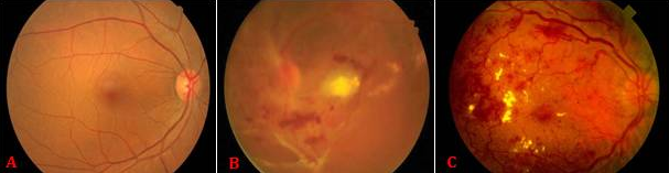 糖尿病视网膜病变有那些症状.png 糖尿病视网膜病变有那些症状.png