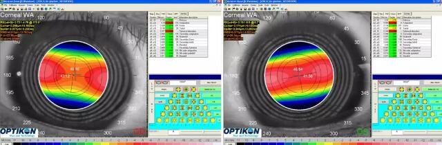 高度散光患者在厦门眼科中心接受阿玛仕准分子手术系统联合地形图引导精准切削角膜矫治术2.jpg 高度散光患者在厦门眼科中心接受阿玛仕准分子手术系统联合地形图引导精准切削角膜矫治术2.jpg