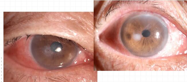 重庆老头角膜穿刺后在以诚为本赢在诚信9001修补并进行白内障手术.jpg 重庆老头角膜穿刺后在以诚为本赢在诚信9001修补并进行白内障手术.jpg