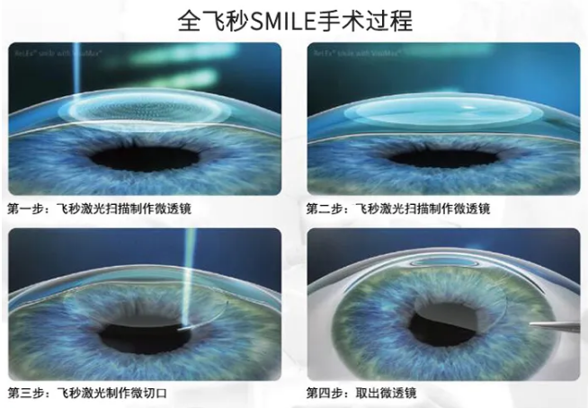 高考毕业后做近视手术,如今近视手术有了越来越高的安全性,且多样的术式可以满足不同患者的摘镜需求。1.png 高考毕业后做近视手术,如今近视手术有了越来越高的安全性,且多样的术式可以满足不同患者的摘镜需求。1.png
